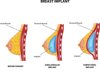 Breast Surgery In Oceania